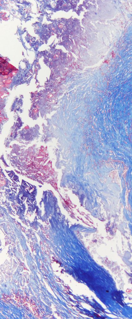 Slide of coronary artery harding that looks like blue and red waves