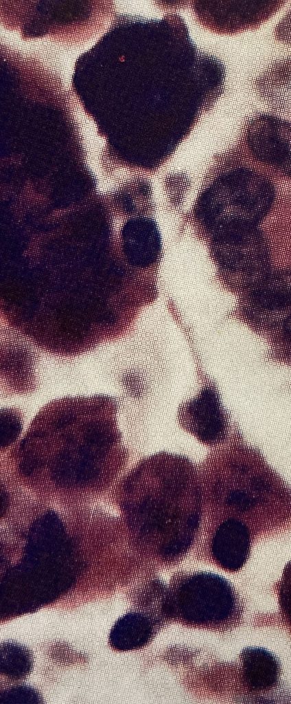 A slide with Whipple's disease, big, circular dark spots